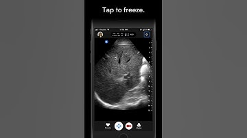 How To Add a Text Annotation | Butterfly Network