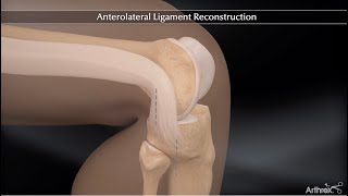 Anterolateral Ligament Reconstruction