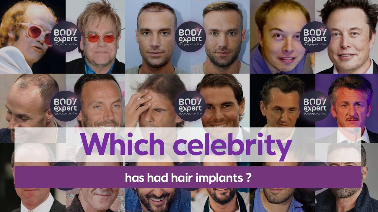 TURKEY HAIR TRANSPLANT | 🤩 Which celebrity has had hair implants |  BODYEXPERT - YouTube