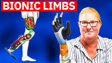 Bionic Limbs & Prosthetic Breakthroughs: Revolutionizing Mobility