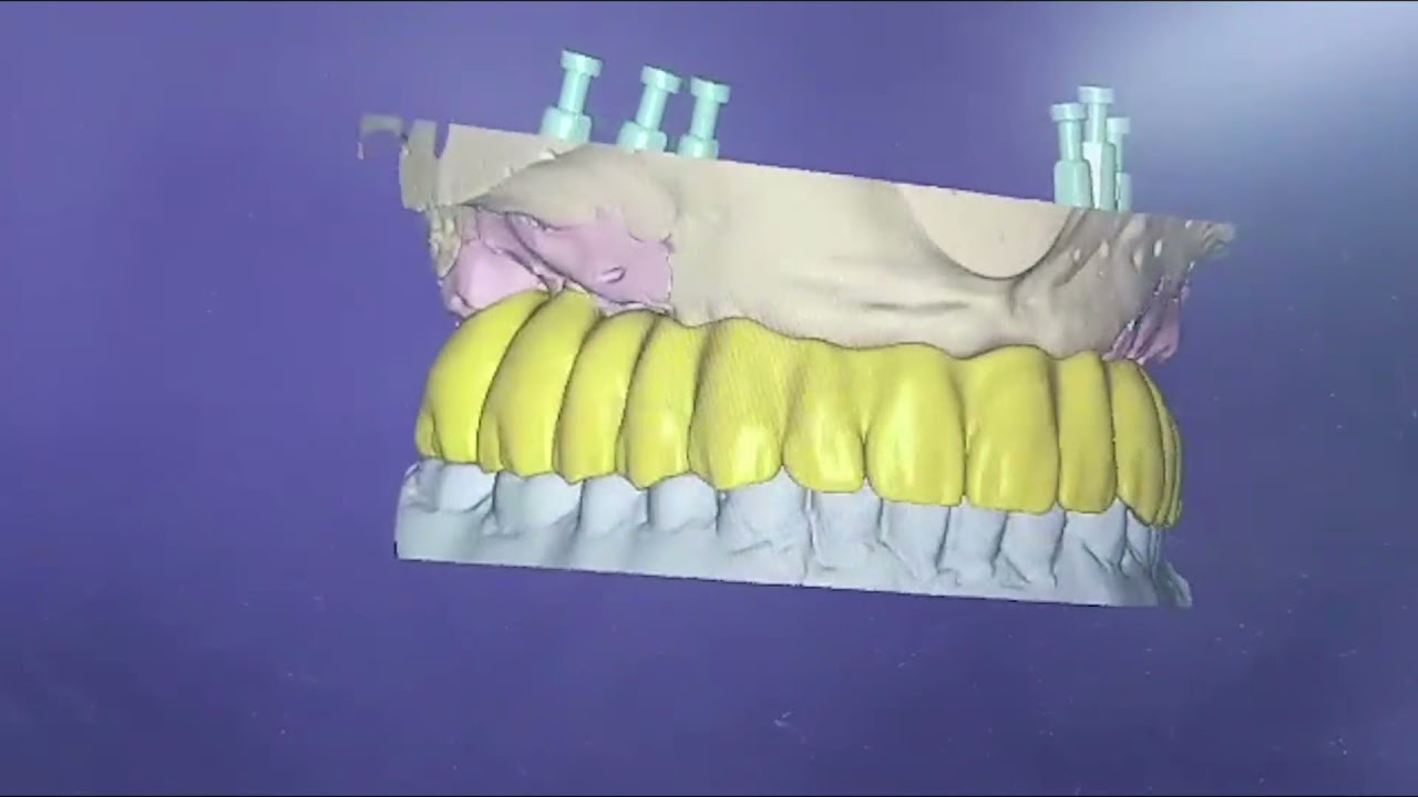 רחל אלבז- השתלת שיניים All On Six