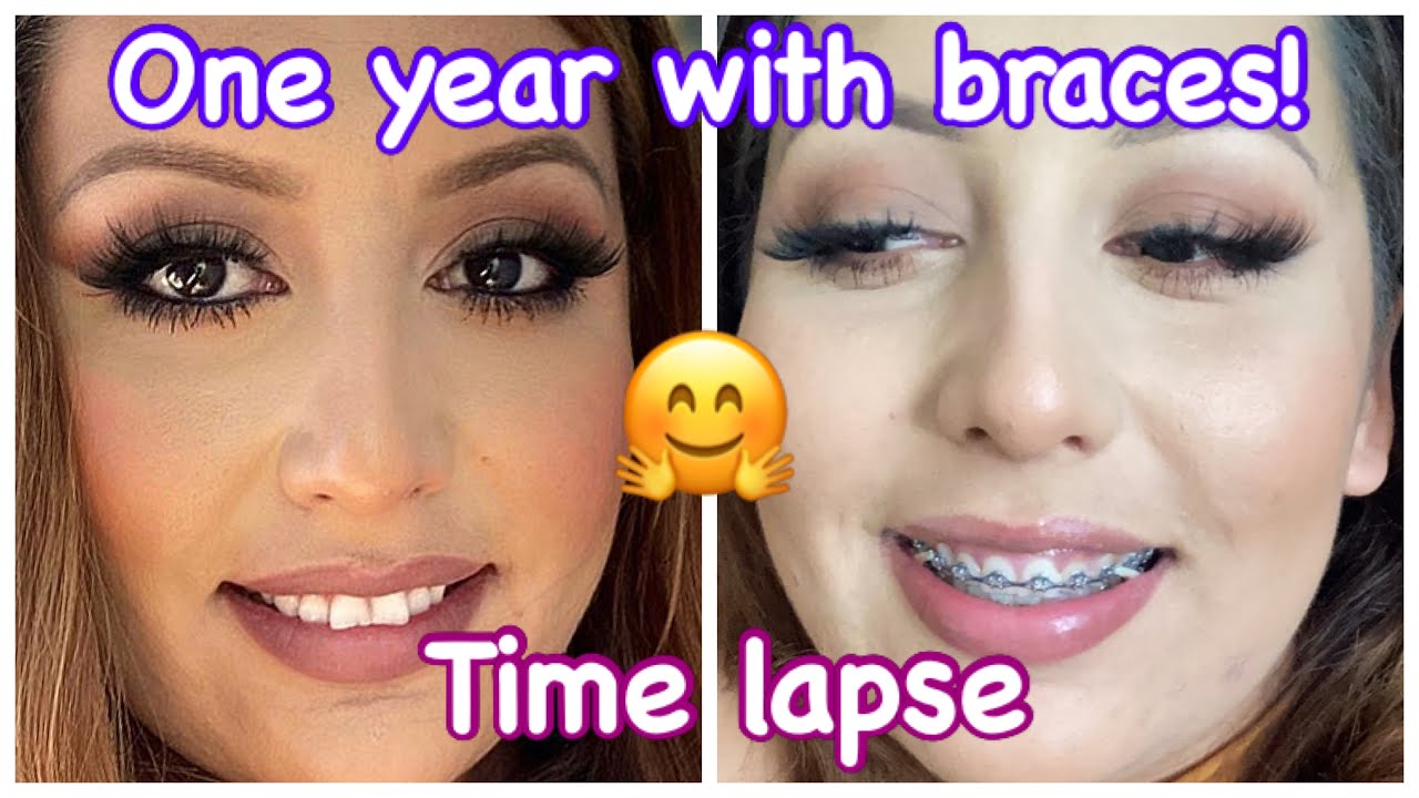 ONE YEAR WITH BRACES Time Lapse Correcting Overjet Overbite Damon Braces