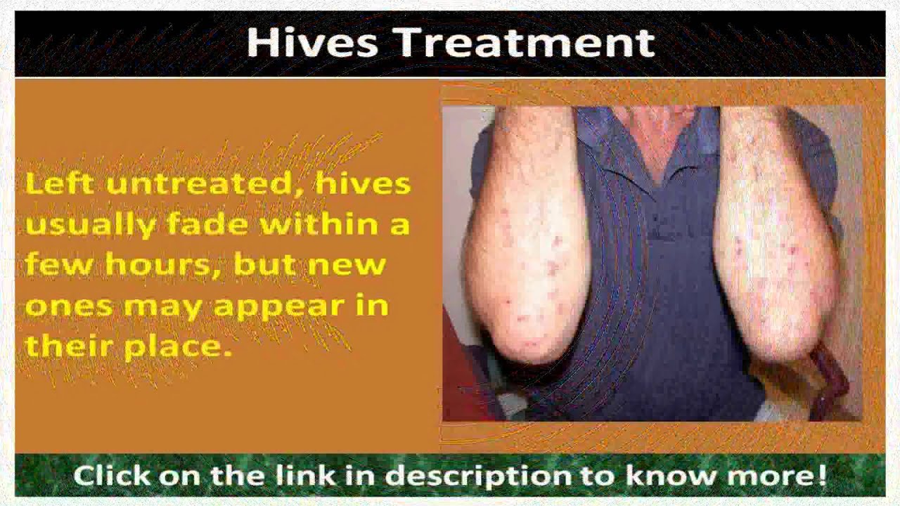 Hives Natural Treatment Youtube