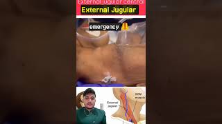 jugular vein cannulation #jugularvein #cannula #emergencycare