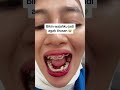 Nyesel banget sumpah 😭😭😭😭 #behelgigi #pasangbehel #fdcdentalclinic