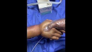 What is Pitting Edema? | How to Identify Edema in Hands #edema #swelling #medical