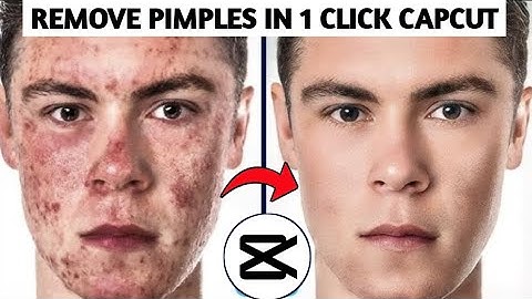 How To Remove Pimples From Video in Capcut || Smooth Skin Video Editing In Capcut || Video Editing