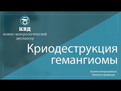 214 Криодеструкция гемангиомы