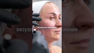 Как создаётся визуальное омоложение? #лифтинглица