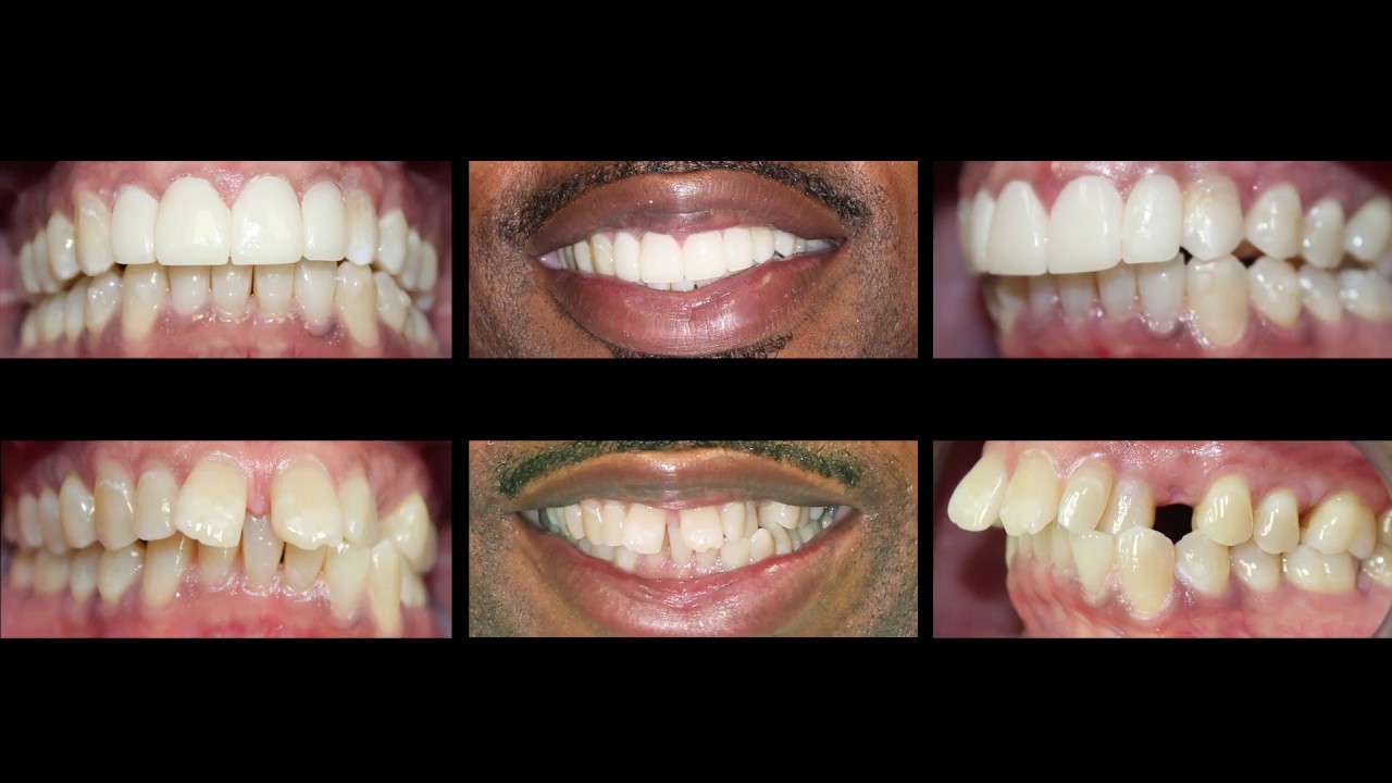 Invisalign and Dental Veneers at Cosmetic Dental ... Invisalign and Dental Veneers at Cosmetic Dental ...