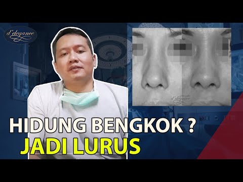 Susah napas sebelah, karena hidung bengkok, bagaimana memperbaikinya?