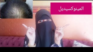 اسباب الصلع النسائي وطرق العلاج Minoxidil