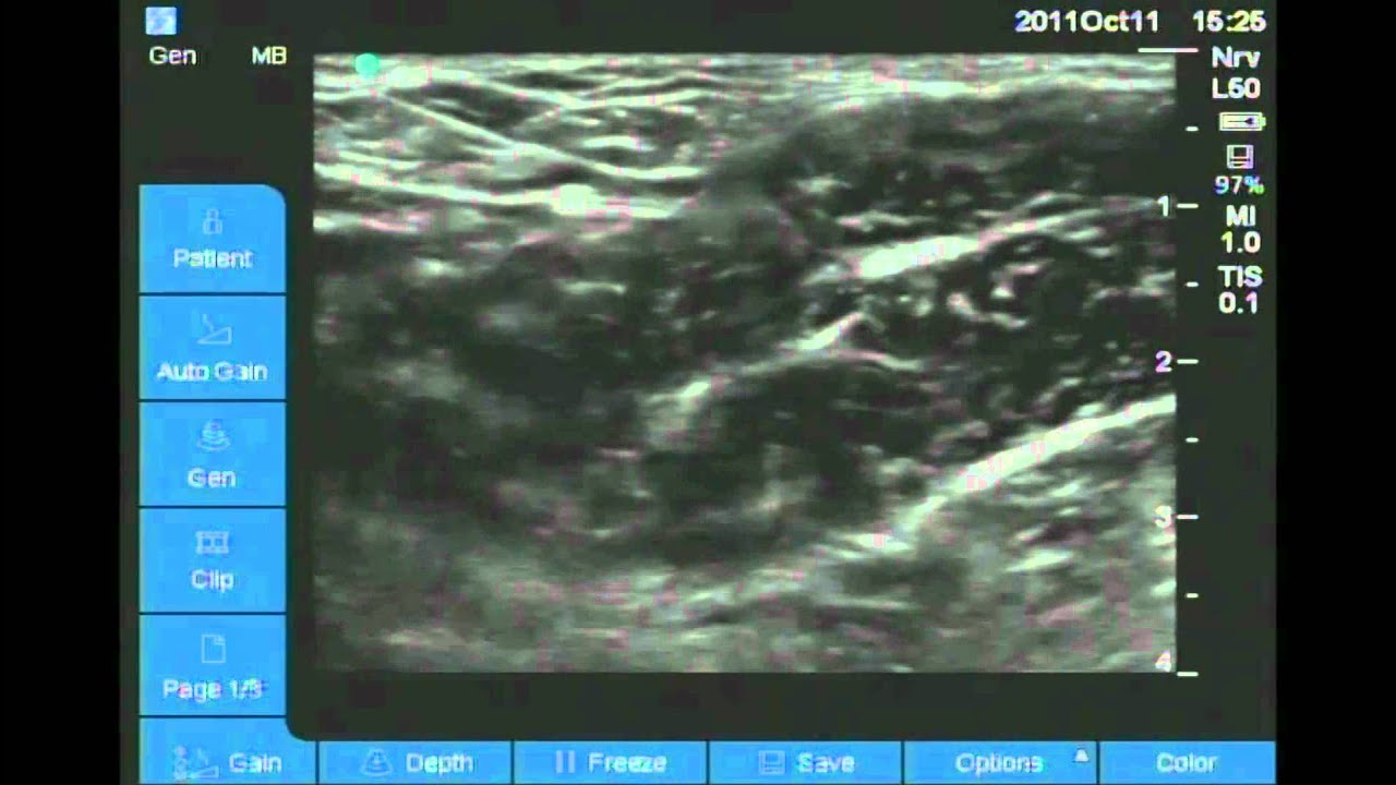 Ultrasound Guided obturator nerve block - YouTube