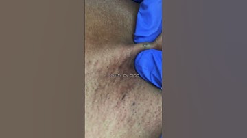 Impacted Pore Removal from Underarm…