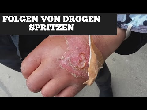 Horror Droge Krokodil in Wien (Warnung !!! heftige Wunden )