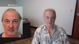 Fort Lauderdale Hair Transplant | Permanent Hair Restoration Results After 1 Year
http://naturaltransplants.com/ CALL 844-327-4247 for your free hair transplant consultation. Fort Lauderdale Hair Transplant Clinic | Permanent Hair Restoration Surgery for Men and Women
At Natural Transplants, Hair Restoration Clinic we only perform hair transplant surgery and nothing else. Share this hair transplant video: https://youtu.be/oysu6IP Bg
Our hair transplant consultations are limited and appointments are needed to speak with one of our hair transplant surgeons. Then you will be able to speak with the doctor face-to-face either online or in person. Call and check availability now so you can ask the doctor anything about your goals and wants for getting a hair transplant.
Natural Transplants, Hair Transplantation Clinic. HUE (High-Yield Unit Extraction®). Hair Transplant Surgery. Call (844) 327-4247.
Getting a hair transplant is a big decision and you need to check around so do your research. Its a major commitment to change the way you look and when you choose your hair transplant surgeon, youll want the very best.
Hair Transplant Surgery in Fort Lauderdale | Natural Transplants Before and After Hair Transplants at our hair clinics. Call us at (844) 327-4247 and speak with a hair transplant specialist and you will be happy to hear that we are not into high-pressure sales techniques. We dont need to as our work speaks for us and the results are outstanding. Youd probably like to know what the cost of a hair transplant?
If you are looking for a fuller, natural looking head of hair that will make you look and feel better, dont be concerned about the hair transplant costs. If you are considering a permanent hair loss solution and are worried about the cost of a hair transplant then relax as Natural Transplants have convenient and affordable hair transplant payment options.
https://youtu.be/WOcF4JBVNfA
All our hair doctors are licensed medical physicians and only perform hair restoration surgeries. We specialize in great hair transplant surgery and the methodology weve developed moves as much as 7 sq inches of the donor area. Thats more hairs than any other procedures performed. Plus, its a scarless incision and you wont be able to see anything but a faint line when your hair is a 1/4 long.
Looking for a great hair transplant in Fort Lauderdale?
Natural Transplants, Hair Restoration Clinic
2601 E. Oakland Park Boulevard, Suite 502
Fort Lauderdale Florida
United States of America 33306
26.167749,-80.114042 Fort Lauderdale Hair Transplant | Permanent Hair Restoration Results After 1 Year