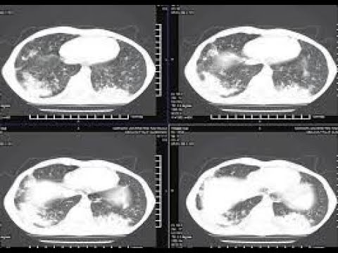 Video: Kriptojenik təşkil edən pnevmoniya interstisial ağciyər xəstəliyidirmi?
