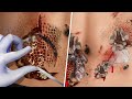 ASMR Treatment Animated Series 1｜trypophobia,pustule treatment,Blackhead removal｜big collection