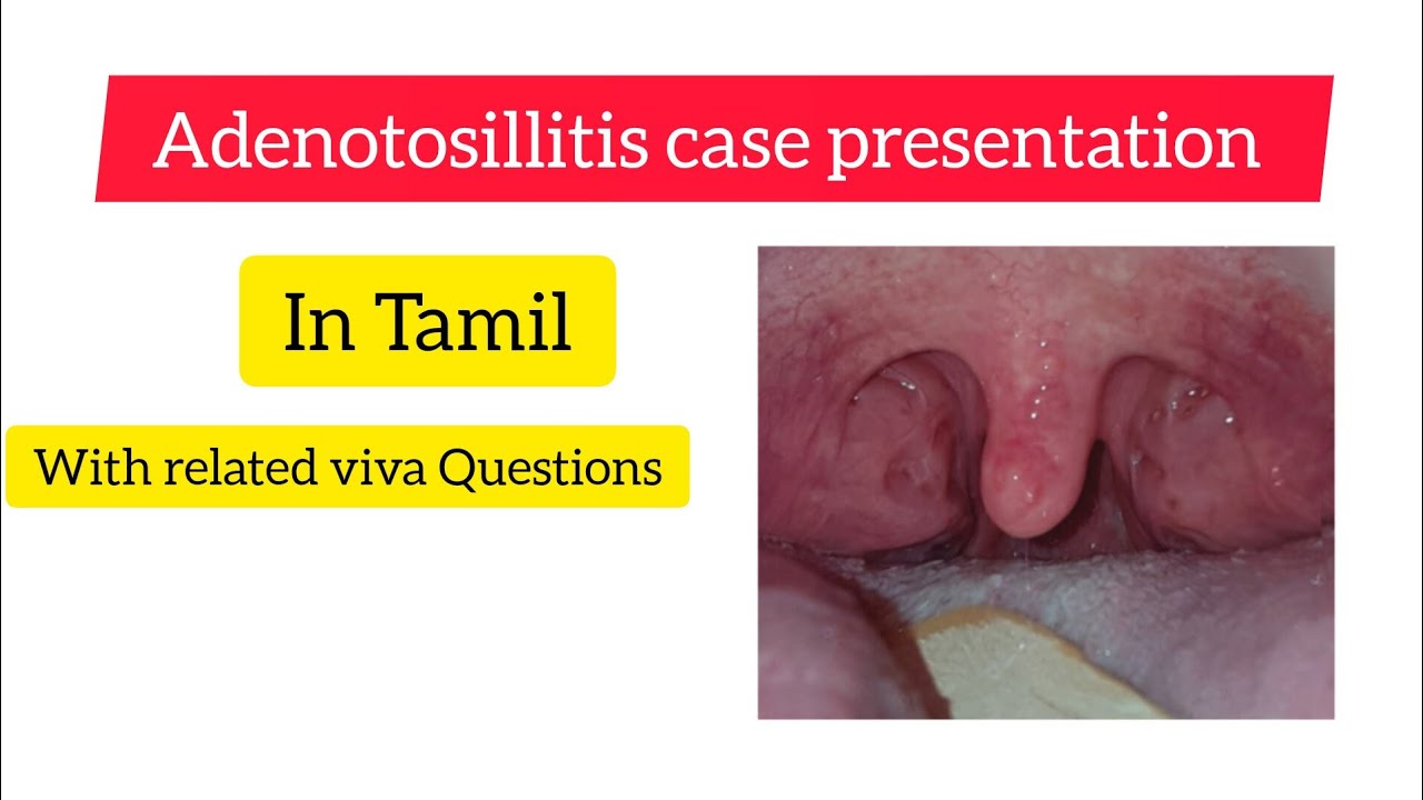 Adenotosillitis Case Presentation With Viva Related Questions In Tamil adenotosillitis-case-presentation-with-viva-related-questions-in-tamil
