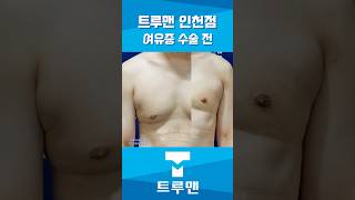 트루맨 인천점에서 여유증 수술 후 탄탄해진 모습.