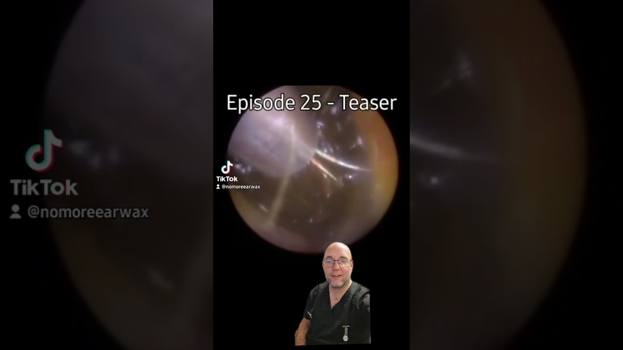 Episode 25 teaser #earwaxremoval #satisfying #ear #viral #microsuction #fyp