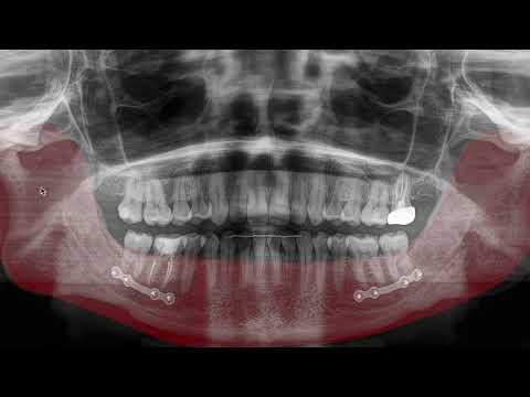 Video: Perché le radiografie panoramiche vengono utilizzate in odontoiatria?