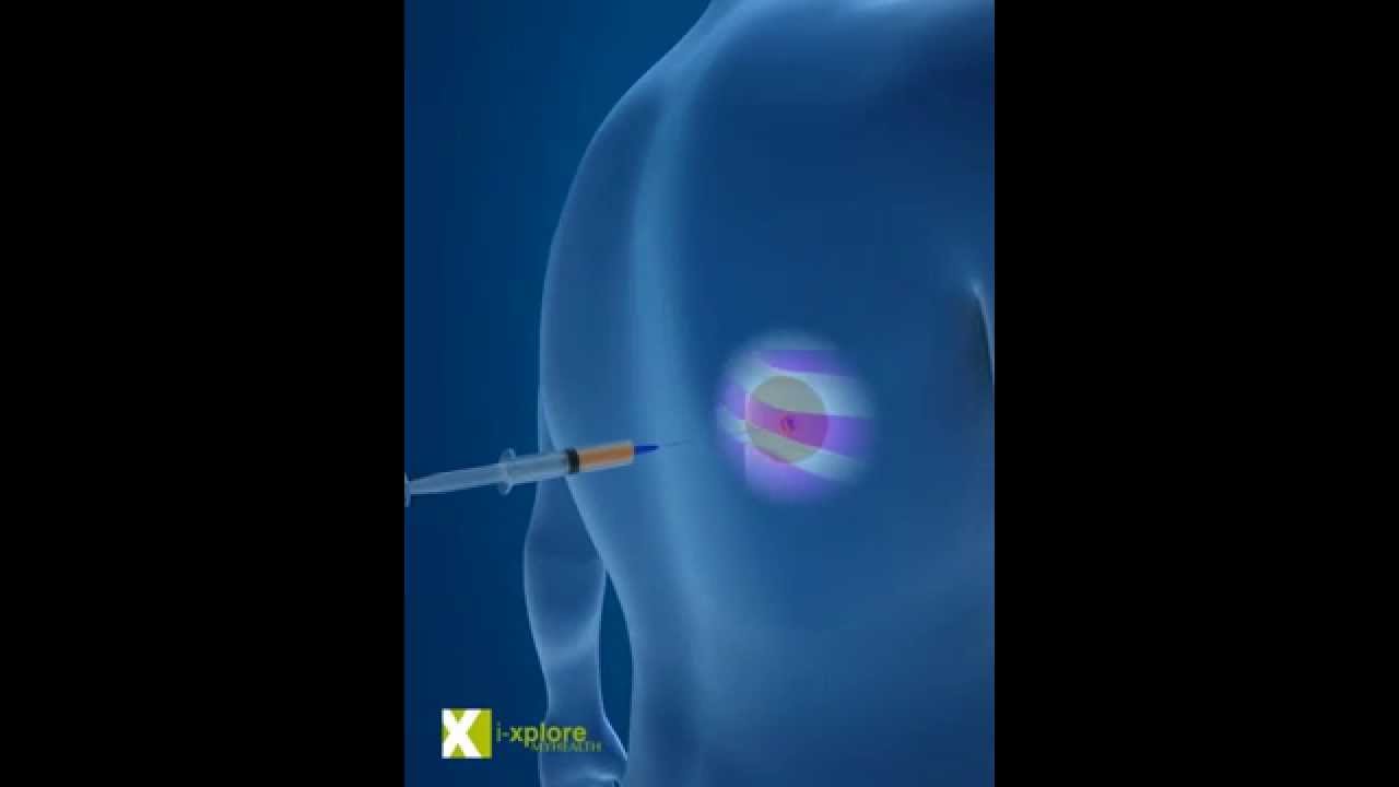 Lung Cancer Biopsy - YouTube