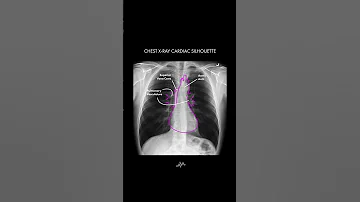 Heart Anatomy On Chest X Ray Shorts 