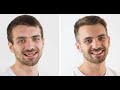 Dentalni makeover 2018 ŠTIMAC CENTRA DENTALNE MEDICINE - Josip