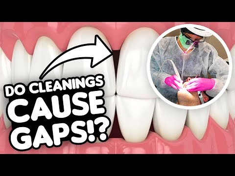 Can Dental Cleanings Cause Gaps Between Teeth