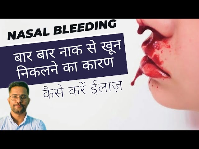 नाक से खून निकलने के कारण । Cause of Nasal Bleeding / Epistexis class=
