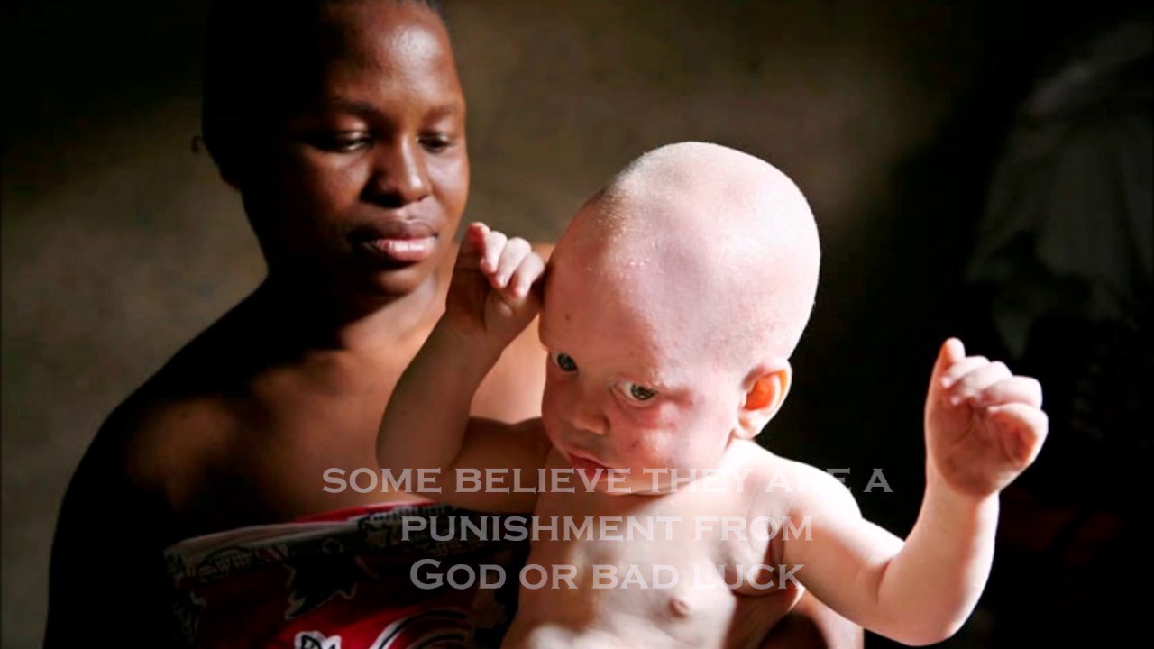 Как люди рождаются альбиносами. Альбинизм негроидная раса.