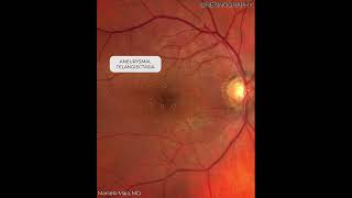 Idiopathic Macular Telangiectasia Multimodal Ysis For More Images Like This Visit .Retinograp