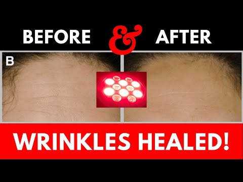 Red Light Therapy Wrinkle Treatment Before and After