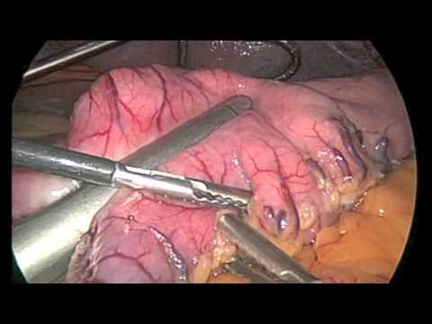 Sleeve Gastrecomy Surgery LIVE by Dr. Alexander Ab...