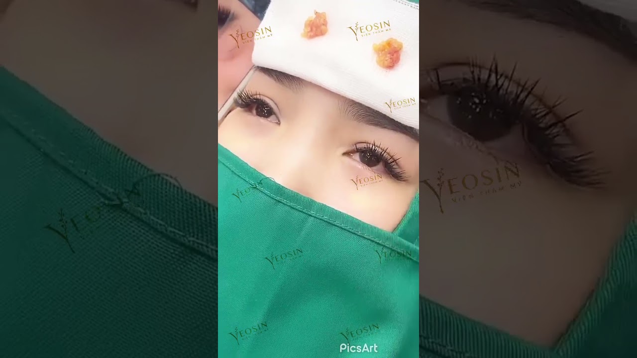 Xóa bọng mỡ mắt - Loại bỏ mỡ thừa, trẻ hóa vùng mắt 12 YouTube video