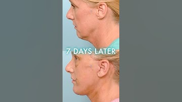 She Got a Facelift and Brow Lift — Here’s How She Looks 7 Days Later #FaceliftBeforeAndAfter