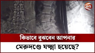 কিভাবে বুঝবেন আপনার মেরুদণ্ডে যক্ষ্মা হয়েছে? || Backbone TB || Channel 24
