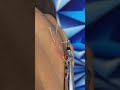 Dry needling #dryneedling #painrelief #acupuncture #hijama #lowbackpain #podcast