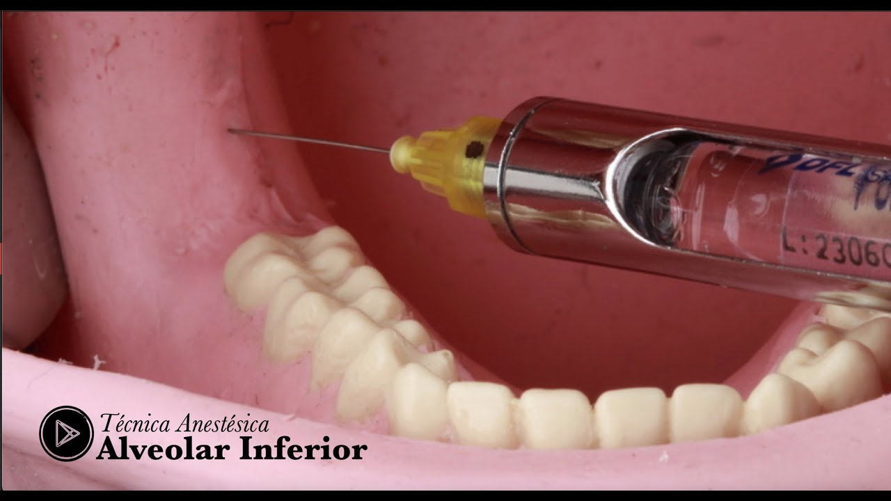 Anestesia Nervo Alveolar Inferior - Sem erros