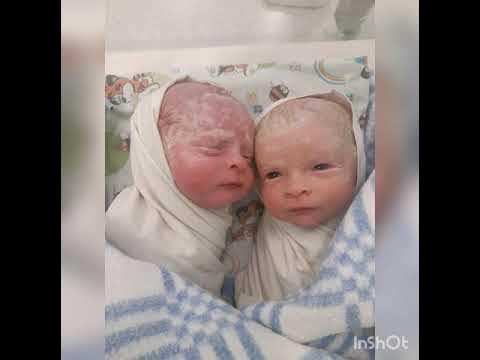 классификация многоплодной беременности. близнецы рожденные естественным путем. близнецы рожденные естественным путем. 11 близнецов мария фернандес. близнецы рожденные естественным путем.