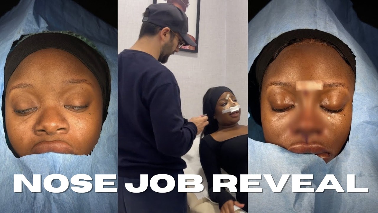 VLOG: ETHNIC RHINOPLASTY CAST OFF AND NOSE JOB REVEAL! SWELLING ...