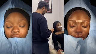 VLOG:  ETHNIC RHINOPLASTY CAST OFF AND NOSE JOB REVEAL! SWELLING, RECOVERY & MORE