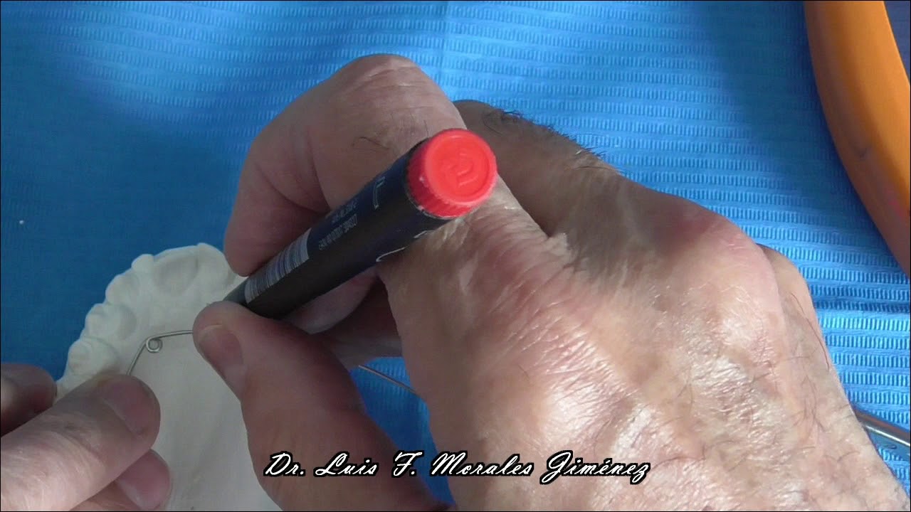 Confeccion del Quad Helix removible