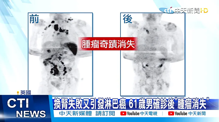 【新聞精華】20210110 奇蹟! 61歲翁癌細胞布全身 確診新冠後"腫瘤消失" - 天天要聞