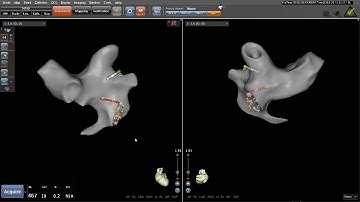 Left Atrial Anatomy using Carto® 3 and  FAM