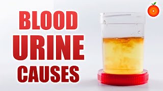 What are the Causes of Blood in Urine? || Orange Health