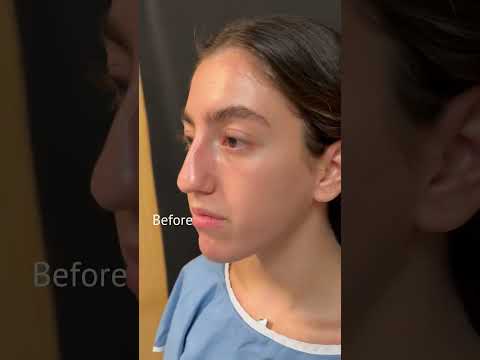 Video thumbnail: Rhinoplasty Before & After | Natural Results by Dr. Robert Morin · Robert Morin MD