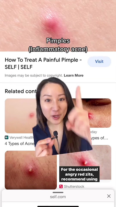 How to Treat Different Types of Acne #shorts