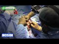 Urethroplasty in India : Kulkarni Technique